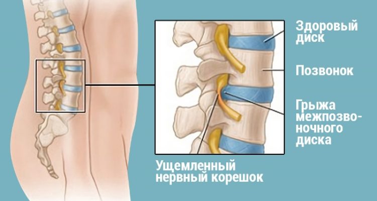 Хирург отговорил меня от операции и посоветовал делать эту зарядку! И ведь помогло!