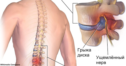 Знакомый хирург посоветовал мне эту зарядку вместо операции. И правда помогло!