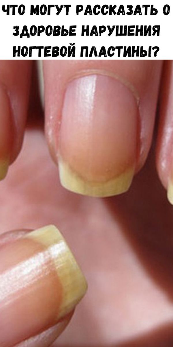 Что могут рассказать о здоровье нарушения ногтевой пластины?