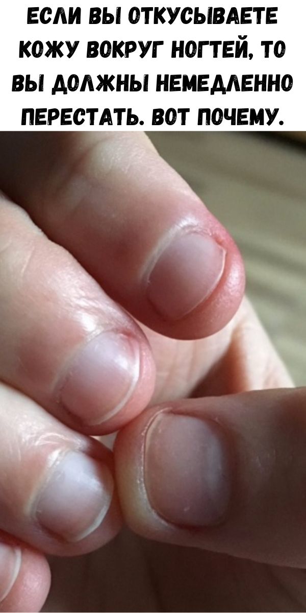 Если вы откусываете кожу вокруг ногтей, то вы должны немедленно перестать. Вот почему.