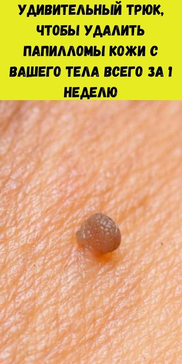 Удивительный трюк, чтобы удалить папилломы кожи с Вашего тела всего за 1 неделю