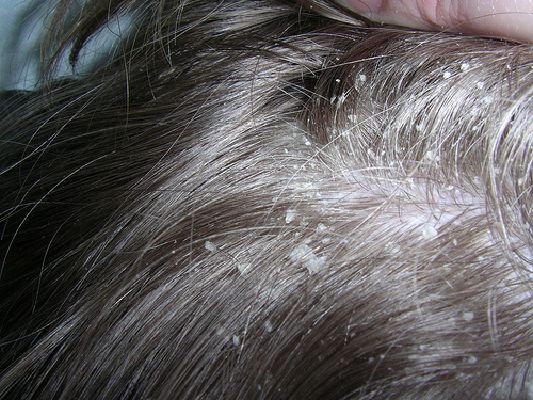 5 ранних предупреждающих признаков проблем кожи головы, которые никогда нельзя игнорировать