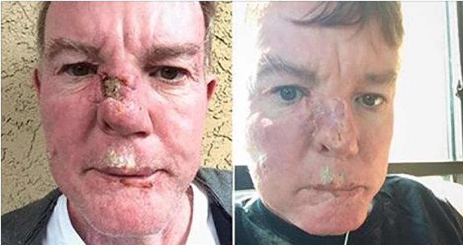 Этот человек нашел собственный метод излечить рак кожи на своем заднем дворе!