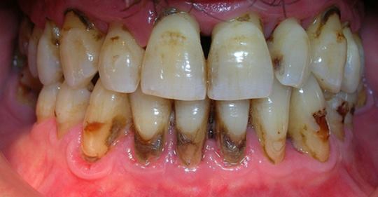 Когда вы увидите этот метод, вы будете сердиться на своего стоматолога за то, что он скрыл это. Вы удалите зубной камень за 2 дня!