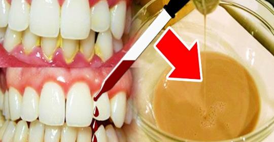 Эти 3 капли удаляют кариес и лечат зубы одновременно