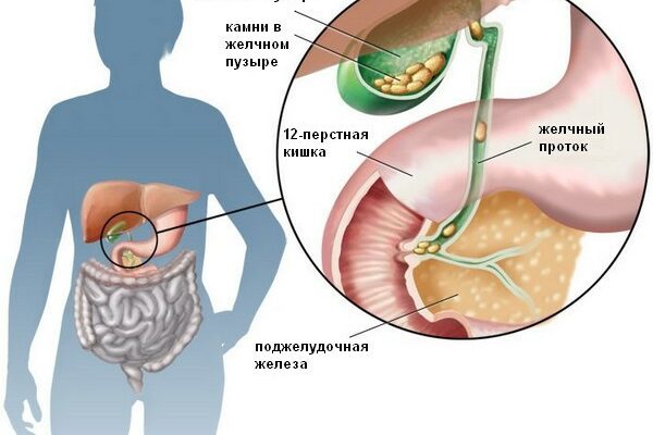 Узнайте способы удаления камней из желчного пузыря без хирургического вмешательства в течение 7 дней!