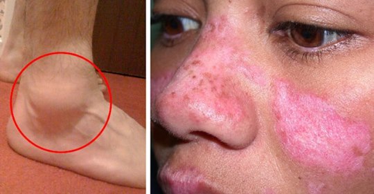 10 ранних признаков волчанки, о которых вы должны знать