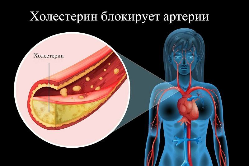 Атеросклероз: Советы травника, как держать сосуды в чистоте