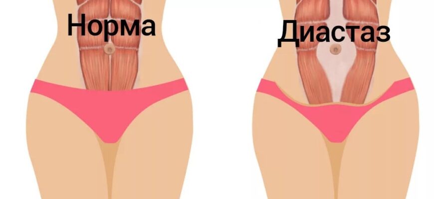 Причина ваших неудач в похудении может заключаться в диастазе! Вся необходимая информация в статье