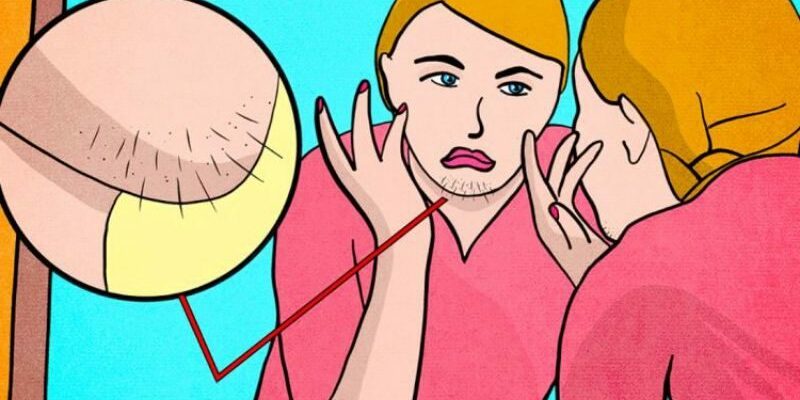 Если у женщины на подбородке появляются волосы: о чем это говорит и как их удалить