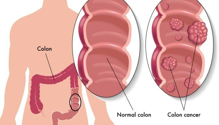 Не игнорируй! 10 Признаков рака толстой кишки!