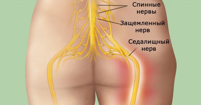 Попрощайтесь с болью в спине! Достижение успеха в 95 % случаев!