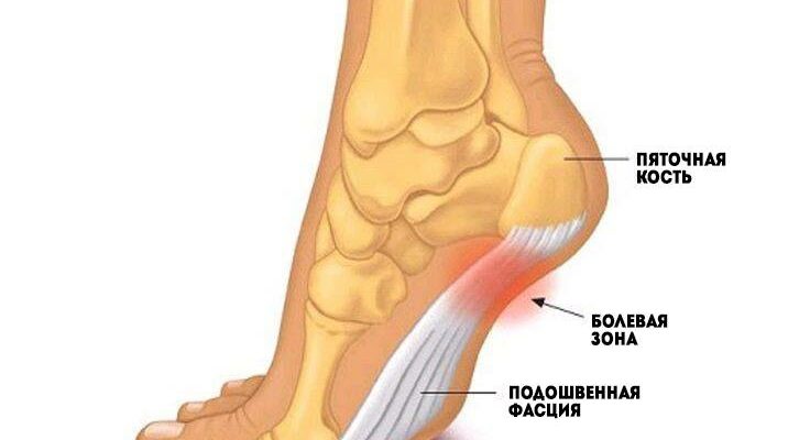 Болит пятка по утрам, всякий раз когда встаете? Вот что вам нужно знать!