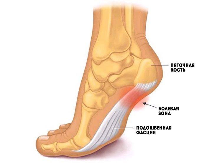 Болит пятка по утрам, всякий раз когда встаете? Вот что вам нужно знать!