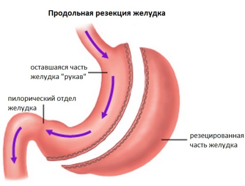 Уменьшаем объем желудка